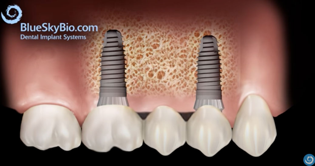 dental implants, dental implant products,