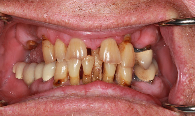 missing teeth, teeth decay, damaged teeth